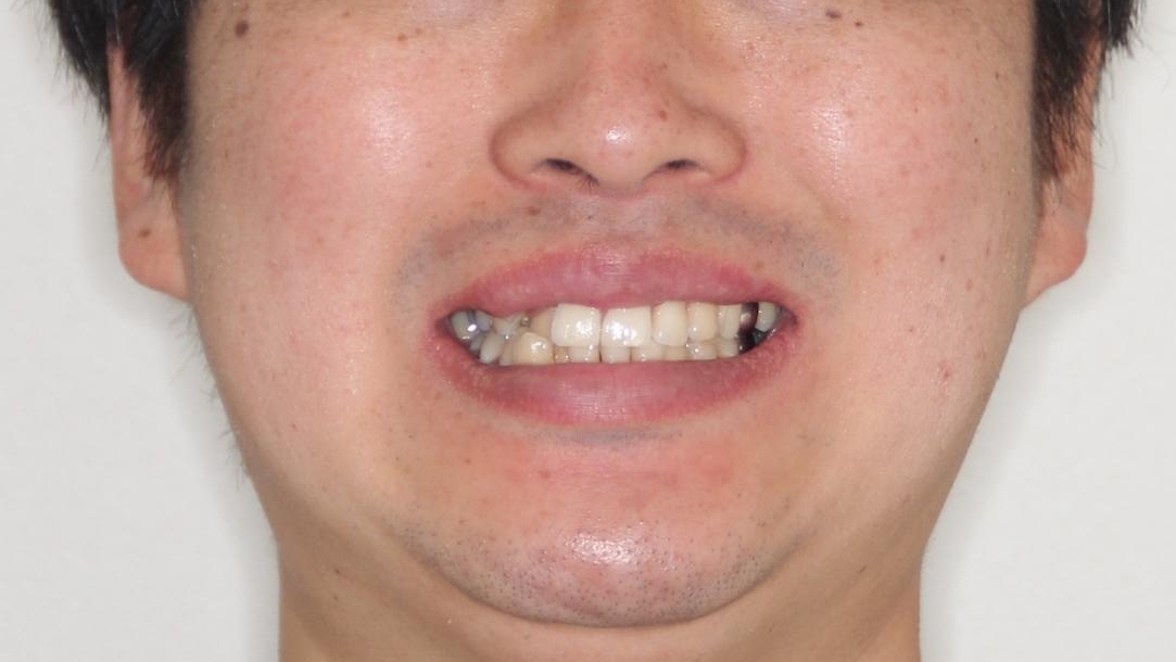【ワイヤー矯正】八重歯と下の歯の凸凹を治したいの治療前(顔貌)