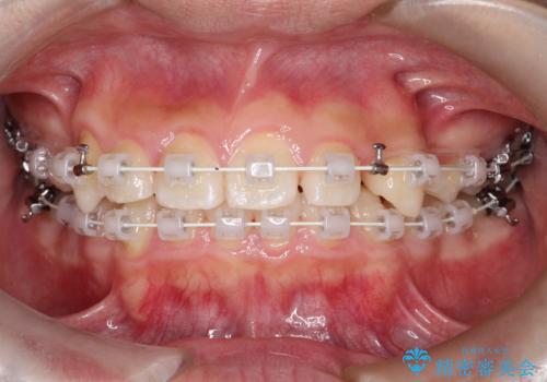 八重歯・歯並びのデコボコとディープバイトを改善した抜歯ワイヤー矯正症例の治療中