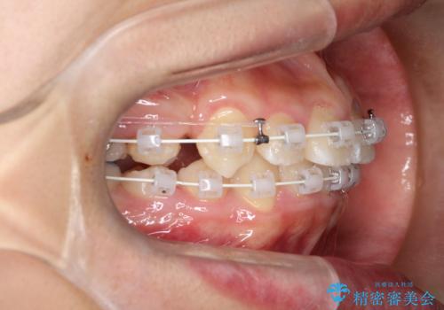 八重歯・歯並びのデコボコとディープバイトを改善した抜歯ワイヤー矯正症例の治療中