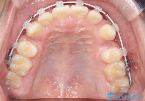 八重歯・歯並びのデコボコとディープバイトを改善した抜歯ワイヤー矯正症例の治療中