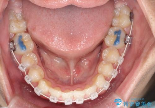 八重歯・歯並びのデコボコとディープバイトを改善した抜歯ワイヤー矯正症例の治療中