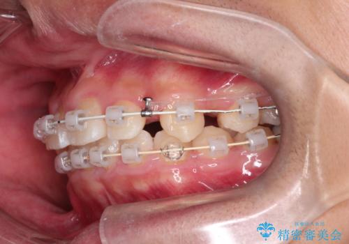 八重歯・歯並びのデコボコとディープバイトを改善した抜歯ワイヤー矯正症例の治療中