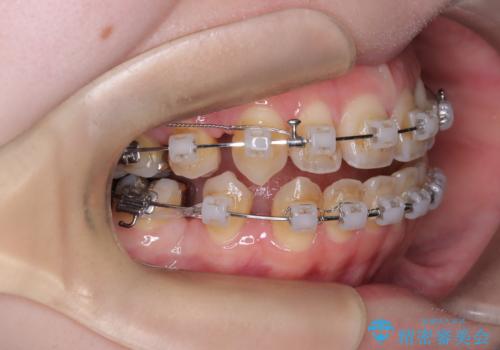 開咬・叢生(八重歯)を抜歯矯正で改善|ワイヤー矯正(クリア装置)症例の治療中