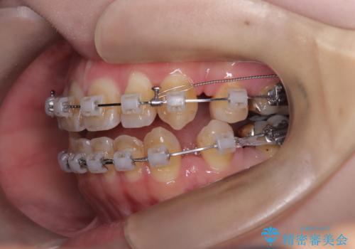 開咬・叢生(八重歯)を抜歯矯正で改善|ワイヤー矯正(クリア装置)症例の治療中