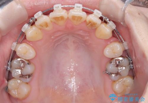 開咬・叢生(八重歯)を抜歯矯正で改善|ワイヤー矯正(クリア装置)症例の治療中