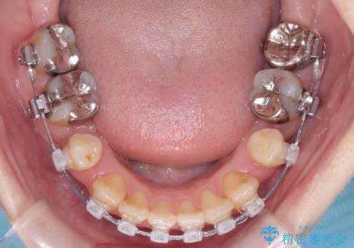 開咬・叢生(八重歯)を抜歯矯正で改善|ワイヤー矯正(クリア装置)症例の治療中