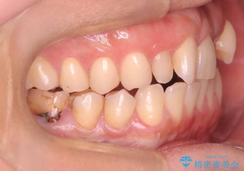 40代から始める歯並び改善。左上の八重歯を抜歯矯正ですっきりとの治療前