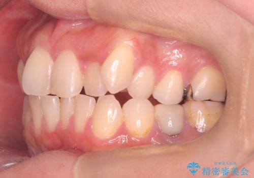 40代から始める歯並び改善。左上の八重歯を抜歯矯正ですっきりとの治療前