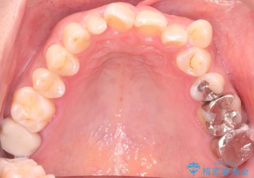40代から始める歯並び改善。左上の八重歯を抜歯矯正ですっきりとの治療前