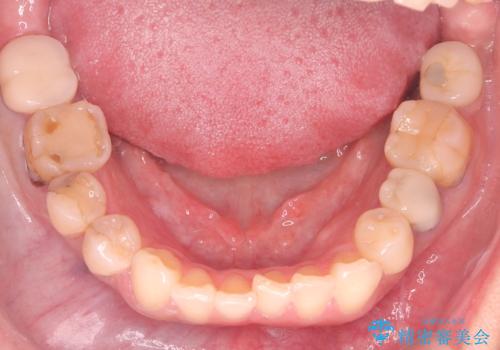 40代から始める歯並び改善。左上の八重歯を抜歯矯正ですっきりとの治療前