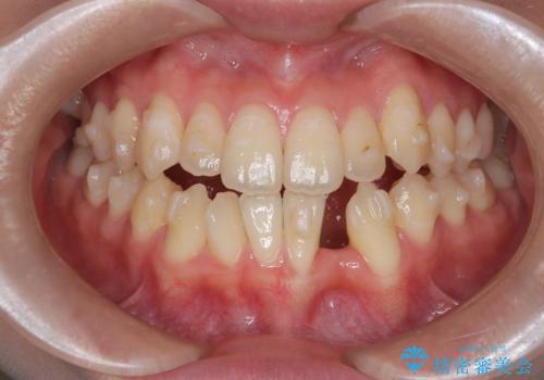 閉院による転院からのリカバリー。インビザラインからワイヤー矯正への切り替えの症例 治療前