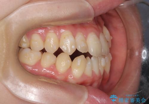 閉院による転院からのリカバリー。インビザラインからワイヤー矯正への切り替えの治療前