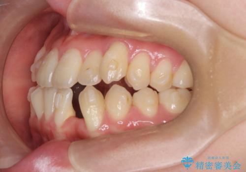 閉院による転院からのリカバリー。インビザラインからワイヤー矯正への切り替えの治療前