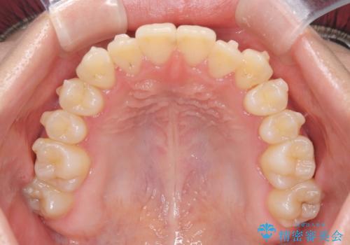 閉院による転院からのリカバリー。インビザラインからワイヤー矯正への切り替えの治療前