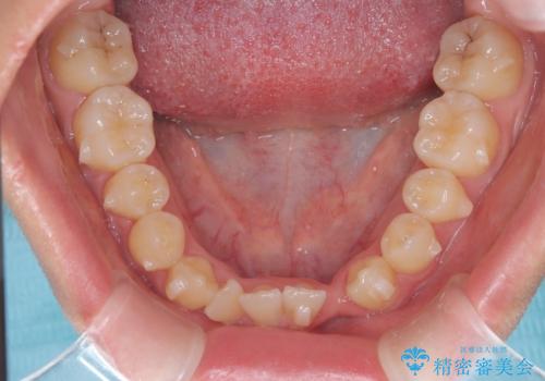 閉院による転院からのリカバリー。インビザラインからワイヤー矯正への切り替えの治療前