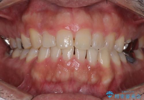 全ての銀歯をセラミックへ。お口全体をメタルフリーにして笑顔まで明るくの症例 治療前