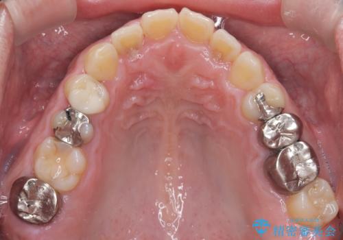 全ての銀歯をセラミックへ。お口全体をメタルフリーにして笑顔まで明るくの治療前