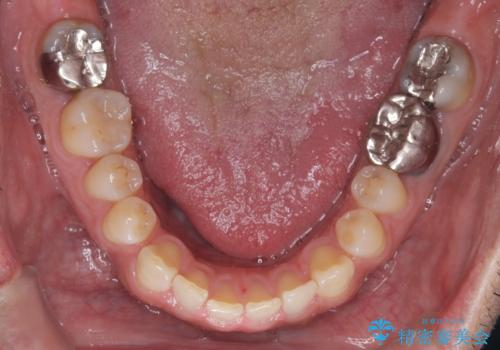 全ての銀歯をセラミックへ。お口全体をメタルフリーにして笑顔まで明るくの治療前