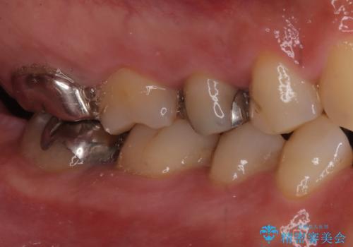 全ての銀歯をセラミックへ。お口全体をメタルフリーにして笑顔まで明るくの治療前