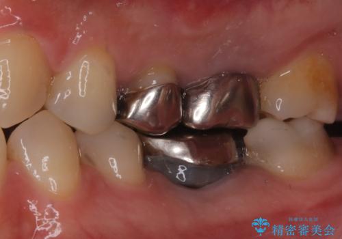 全ての銀歯をセラミックへ。お口全体をメタルフリーにして笑顔まで明るくの治療前