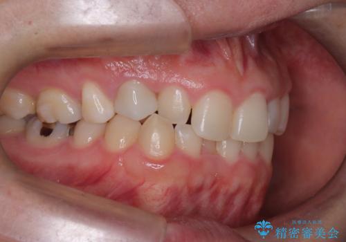 前歯のガタつきと逆の噛み合わせを、短期間のインビザラインで改善の治療前