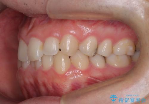 前歯のガタつきと逆の噛み合わせを、短期間のインビザラインで改善の治療前