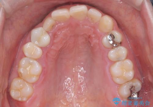 前歯のガタつきと逆の噛み合わせを、短期間のインビザラインで改善の治療前