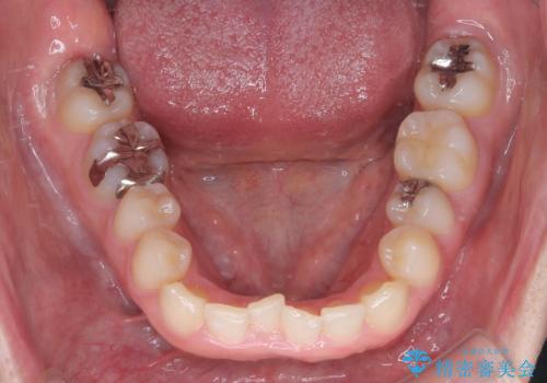 前歯のガタつきと逆の噛み合わせを、短期間のインビザラインで改善の治療前