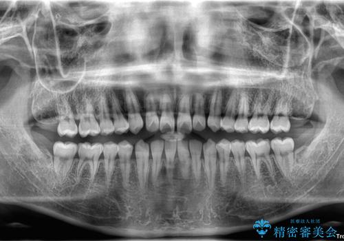 すきっ歯は放置NG?インビザラインで目立たず改善の治療前