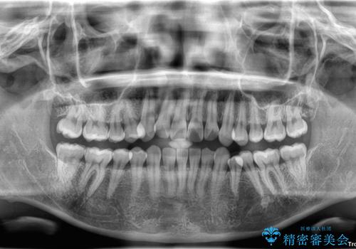 デコボコと正中のずれを改善した矯正治療の治療前