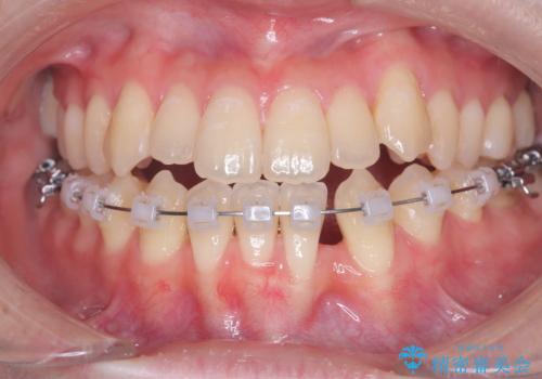 閉院による転院からのリカバリー。インビザラインからワイヤー矯正への切り替えの治療中