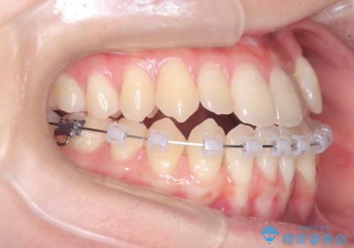 閉院による転院からのリカバリー。インビザラインからワイヤー矯正への切り替えの治療中