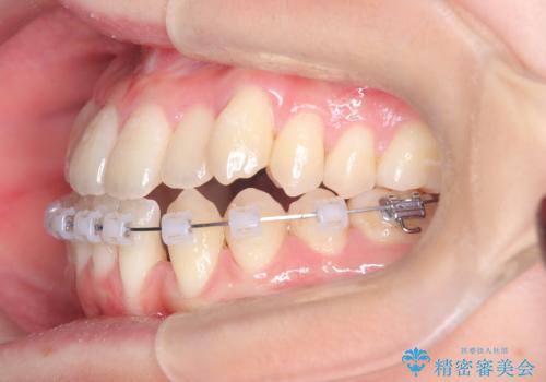 閉院による転院からのリカバリー。インビザラインからワイヤー矯正への切り替えの治療中