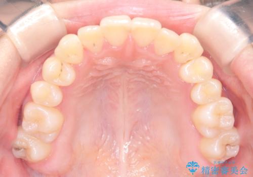 閉院による転院からのリカバリー。インビザラインからワイヤー矯正への切り替えの治療中