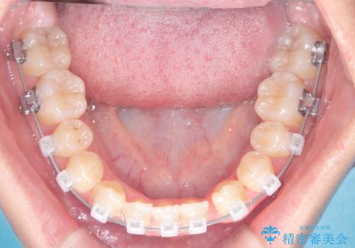 閉院による転院からのリカバリー。インビザラインからワイヤー矯正への切り替えの治療中