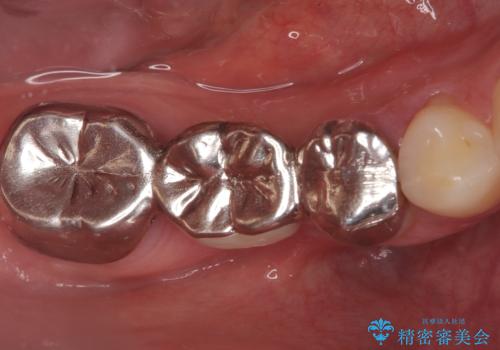 ブリッジからインプラントへの移行と歯周形成外科の治療前