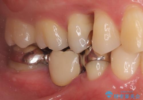 ブリッジからインプラントへの移行と歯周形成外科の治療前