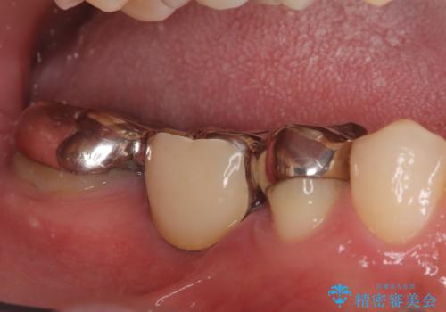 ブリッジからインプラントへの移行と歯周形成外科の症例 治療前