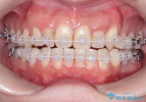 40代から始める歯並び改善。左上の八重歯を抜歯矯正ですっきりとの治療中