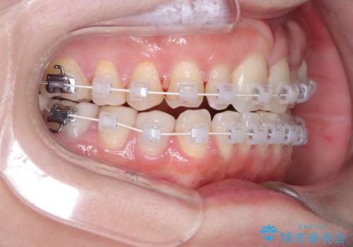 40代から始める歯並び改善。左上の八重歯を抜歯矯正ですっきりとの治療中