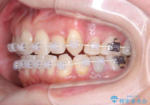 40代から始める歯並び改善。左上の八重歯を抜歯矯正ですっきりとの治療中