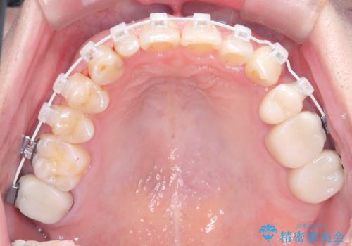 40代から始める歯並び改善。左上の八重歯を抜歯矯正ですっきりとの治療中