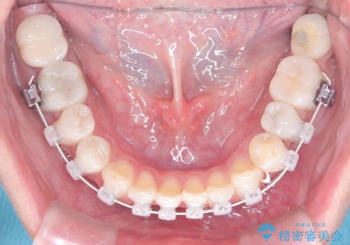 40代から始める歯並び改善。左上の八重歯を抜歯矯正ですっきりとの治療中