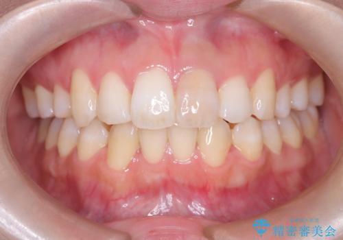 前歯の気になる変色を解消。再根管治療とオールセラミックで自然な美しさへの治療前