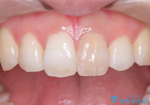 前歯の気になる変色を解消。再根管治療とオールセラミックで自然な美しさへの症例 治療前