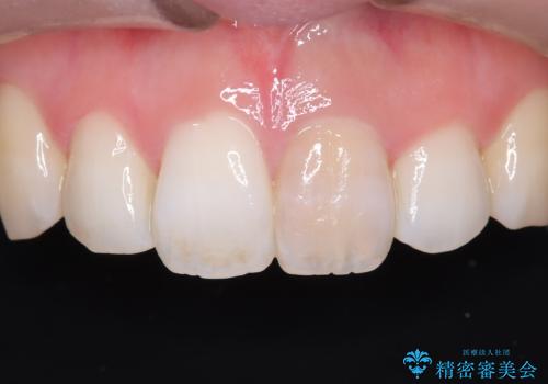 前歯の気になる変色を解消。再根管治療とオールセラミックで自然な美しさへの治療前