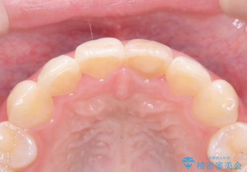 前歯の気になる変色を解消。再根管治療とオールセラミックで自然な美しさへの治療前