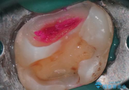 神経を抜かずに守る。MTAを用いた部分的断髄法と精密セラミック修復の治療前