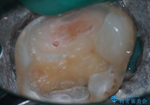 神経を抜かずに守る。MTAを用いた部分的断髄法と精密セラミック修復の治療中