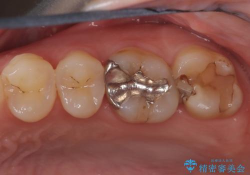 神経を抜かずに守る。MTAを用いた部分的断髄法と精密セラミック修復の症例 治療前